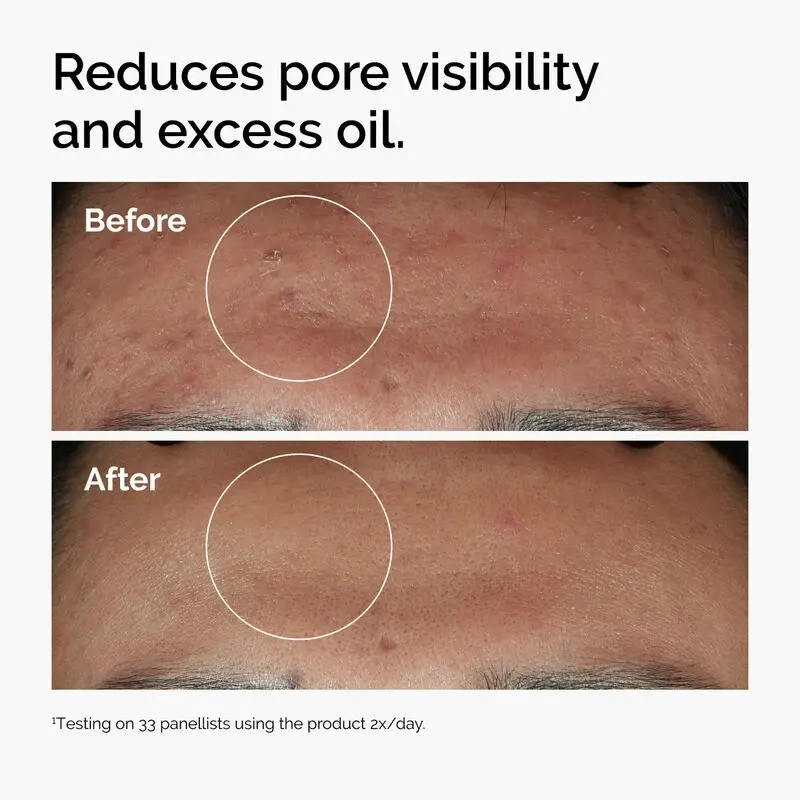 ord-niacinamide-zinc-blemish-serum-before-after-pores.webp