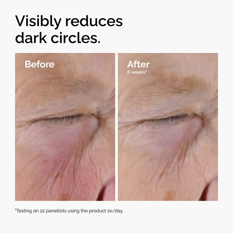 ord-caffeine-solution-egcg-dark-circles-before-after.webp