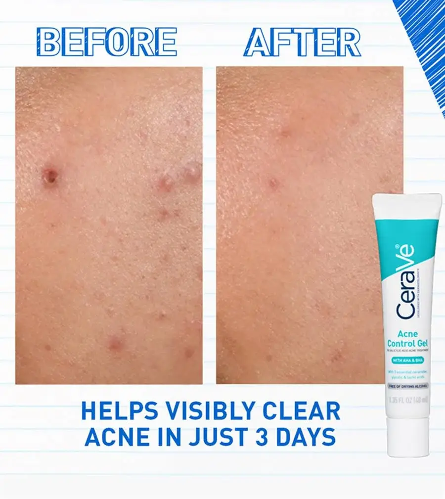 acne-control-gel-ba2-desktop-700x785-v1.webp